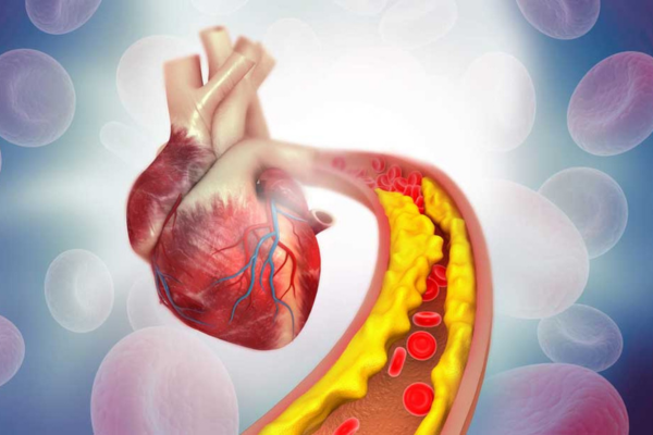 Cholesterol in Heart Artery
