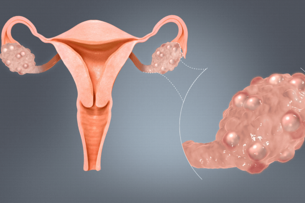 Polycystic Ovary